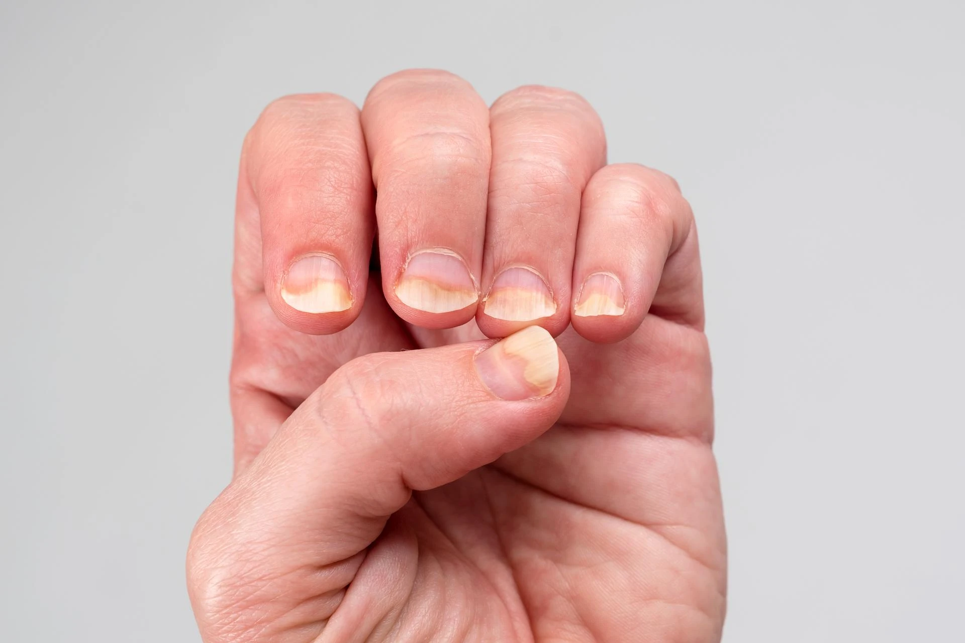Lichen Planus of Nails